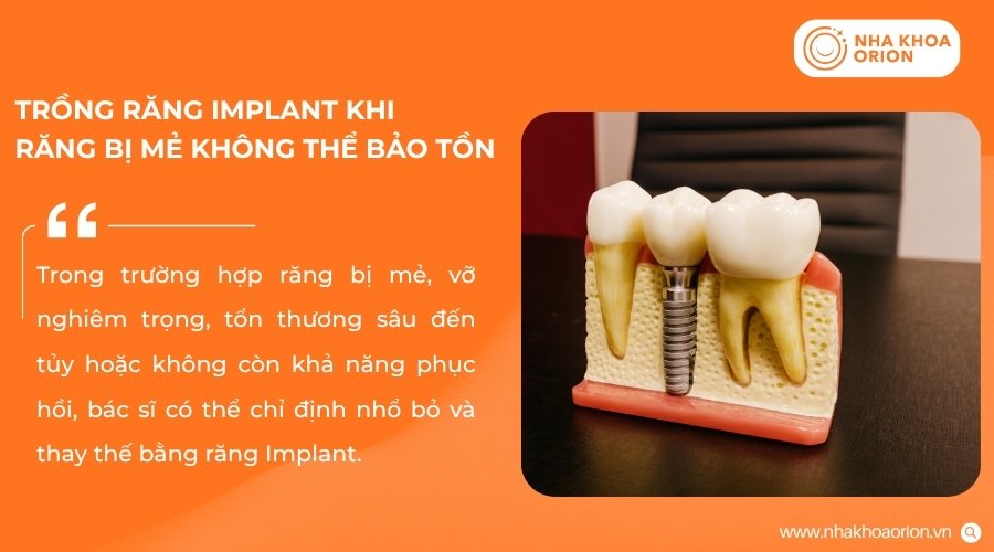 Implant giúp thay thế răng mẻ nghiêm trọng không còn khả năng phục hồi