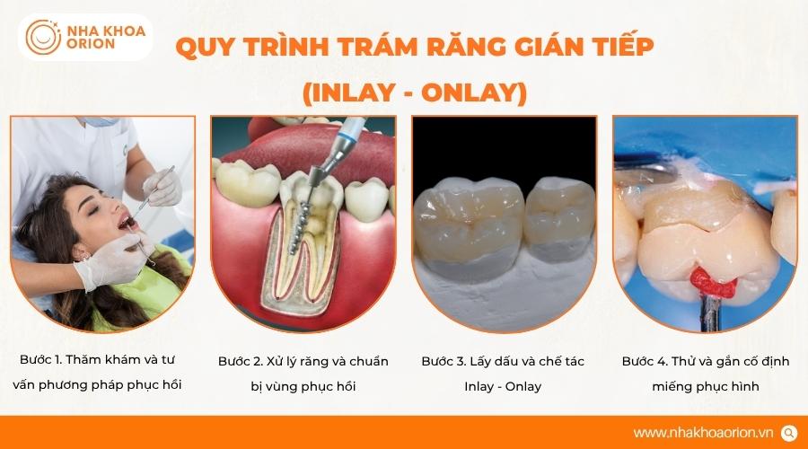 Tr&aacute;m răng gi&aacute;n tiếp Inlay - Onlay sử dụng miếng tr&aacute;m chế t&aacute;c ri&ecirc;ng để phục hồi răng&nbsp;