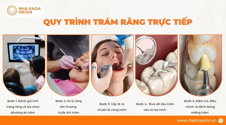 Quy tr&igrave;nh tr&aacute;m răng trực tiếp gi&uacute;p phục hồi răng tổn thương nhanh ch&oacute;ng&nbsp;