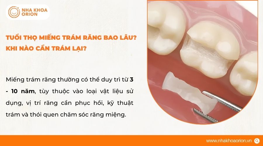 Miếng tr&aacute;m răng c&oacute; độ bền kh&aacute;c nhau t&ugrave;y vật liệu v&agrave; c&aacute;ch chăm s&oacute;c