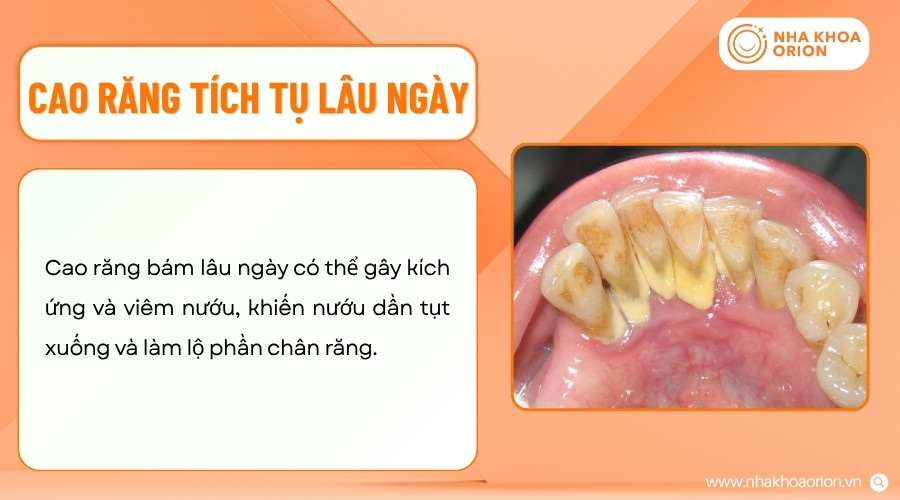 Cao răng l&acirc;u ng&agrave;y c&oacute; thể g&acirc;y vi&ecirc;m nướu, l&agrave;m lộ ch&acirc;n răng, tăng nguy cơ tổn thương