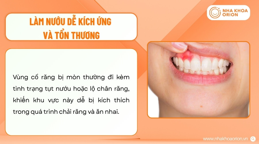 M&ograve;n cổ răng k&egrave;m tụt nướu c&oacute; thể khiến m&ocirc; nướu dễ k&iacute;ch ứng v&agrave; tổn thương hơn