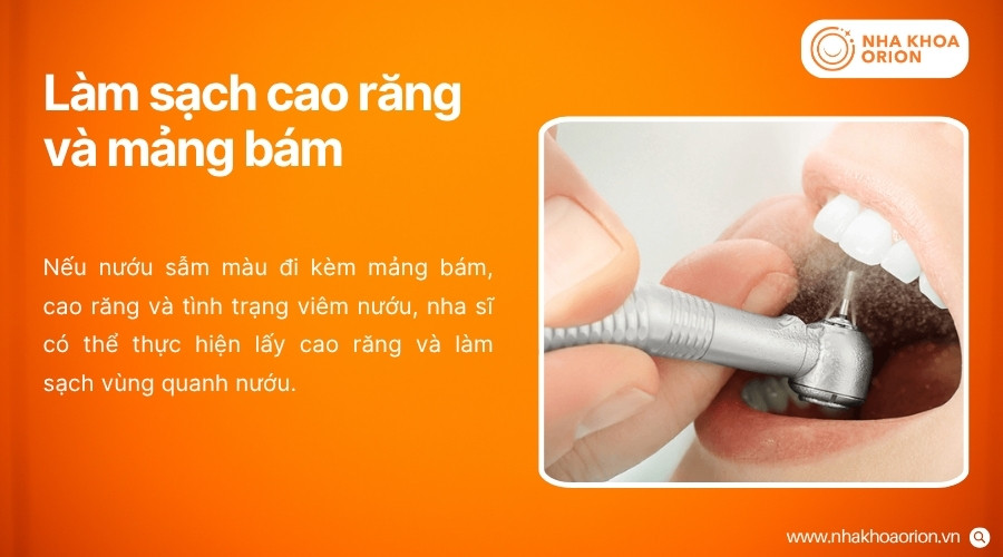 Làm sạch cao răng giúp loại bỏ mảng bám và giảm các yếu tố gây kích ứng mô nướu