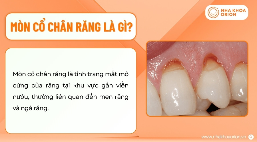 M&ograve;n cổ ch&acirc;n răng l&agrave;m hao hụt m&ocirc; răng tại khu vực tiếp gi&aacute;p giữa th&acirc;n răng v&agrave; ch&acirc;n răng
