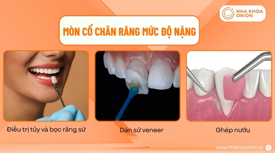 Tổn thương nặng c&oacute; thể cần phục hồi răng, điều trị tủy hoặc can thiệp nướu t&ugrave;y t&igrave;nh trạng