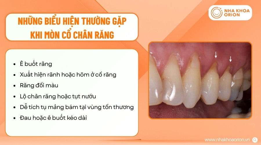 M&ograve;n cổ ch&acirc;n răng thường g&acirc;y &ecirc; buốt, thay đổi d&aacute;ng răng v&agrave; ảnh hưởng đến v&ugrave;ng nướu