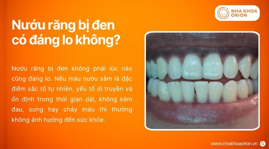 Nướu răng bị đen cần được đánh giá dựa trên nguyên nhân và các triệu chứng đi kèm