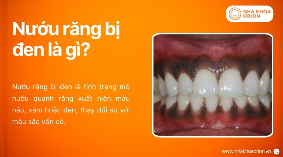 Nướu răng bị đen biểu hiện qua sự thay đổi màu sắc bất thường của mô nướu quanh răng
