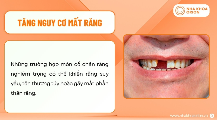 M&ograve;n cổ răng nghi&ecirc;m trọng c&oacute; thể l&agrave;m răng suy yếu v&agrave; giảm khả năng bảo tồn răng l&acirc;u d&agrave;i