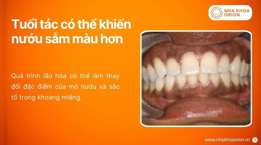 Tuổi tác làm thay đổi đặc điểm mô nướu và có thể khiến màu sắc nướu đậm hơn