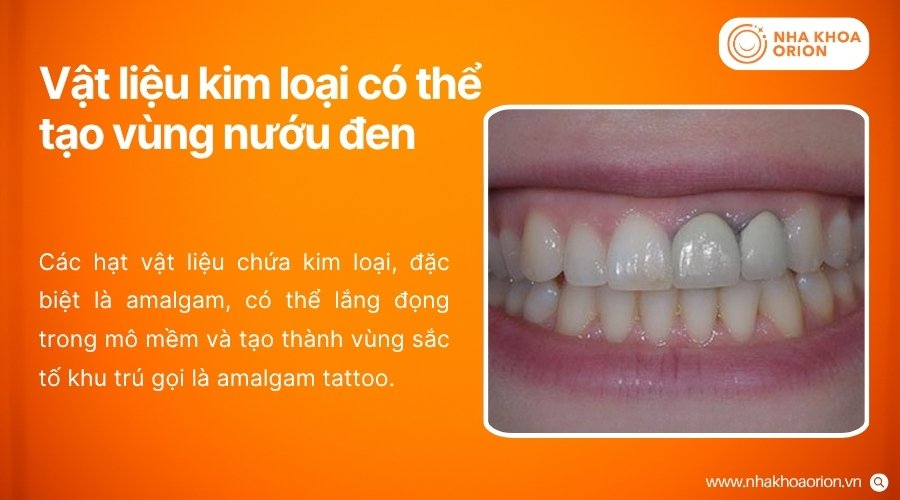 Vật liệu kim loại trong phục hình có thể khiến mô nướu xuất hiện vùng xám hoặc đen