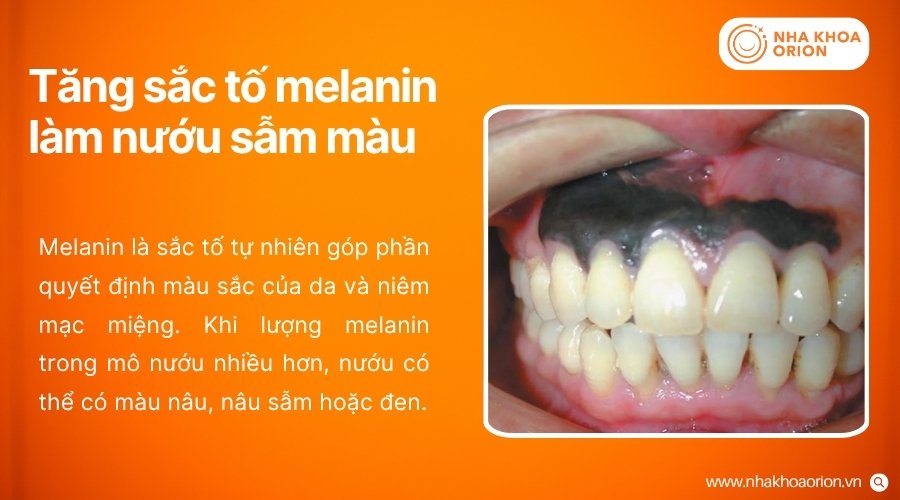 Sắc tố melanin tăng cao khiến mô nướu chuyển sang màu nâu hoặc đen