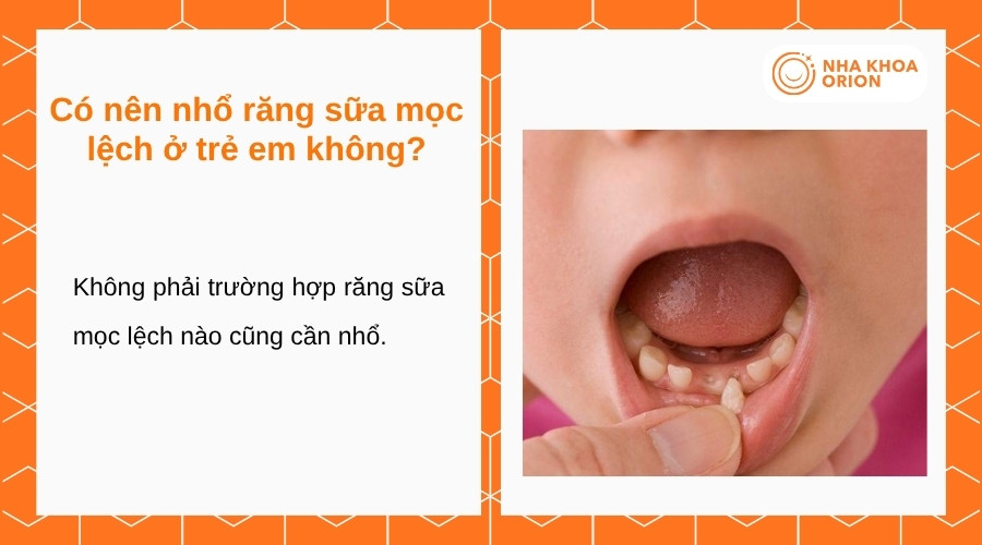 Răng sữa mọc lệch chỉ nên nhổ khi bác sĩ xác định có chỉ định phù hợp