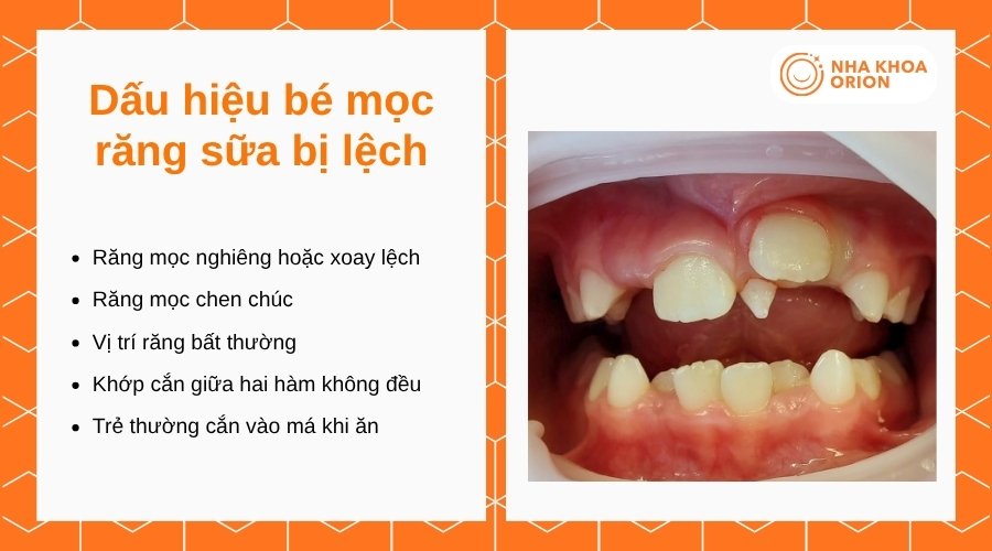 Răng sữa mọc lệch thường biểu hiện qua vị trí, hướng mọc và tương quan giữa các răng