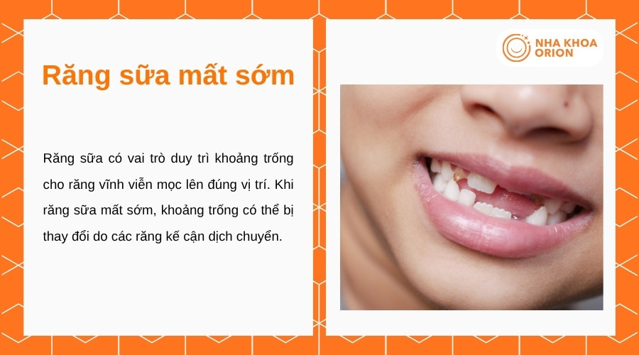 Răng sữa mất sớm có thể làm thay đổi khoảng trống dành cho răng vĩnh viễn