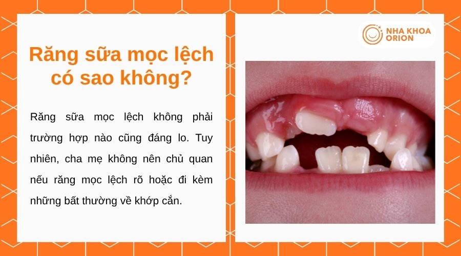 Răng sữa mọc lệch có thể không đáng lo nhưng cần được theo dõi khi xuất hiện bất thường