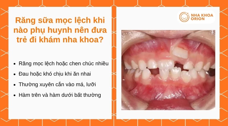 Cha mẹ nên đưa trẻ đi khám khi răng lệch rõ hoặc xuất hiện bất thường khi ăn nhai
