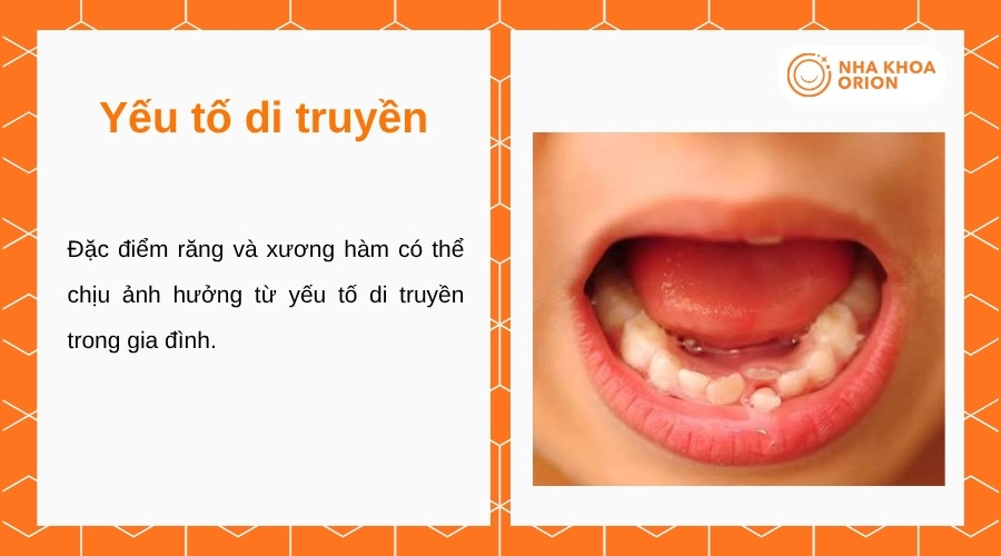 Yếu tố di truyền có thể tác động đến đặc điểm răng và cấu trúc xương hàm của trẻ