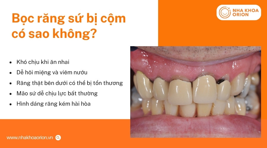 Răng sứ bị cộm k&eacute;o d&agrave;i c&oacute; thể ảnh hưởng đến ăn nhai, răng nướu v&agrave; độ bền m&atilde;o sứ