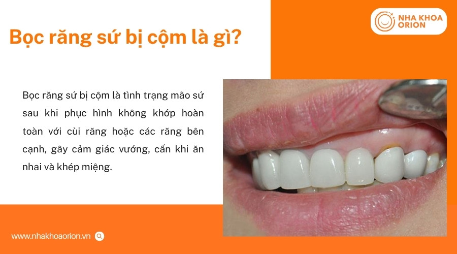 M&atilde;o sứ bị cộm g&acirc;y cảm gi&aacute;c vướng, cấn khi ăn nhai hoặc kh&eacute;p miệng