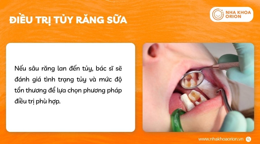 Điều trị tủy giúp bảo tồn răng khi tủy bị tổn thương