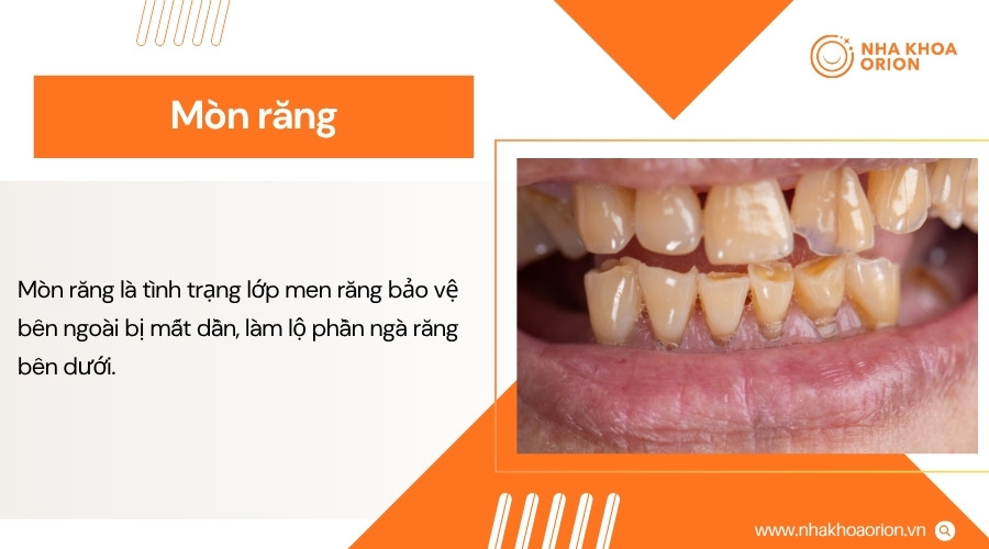 Mòn răng làm mất dần men răng và có thể gây ê buốt hoặc sứt mẻ