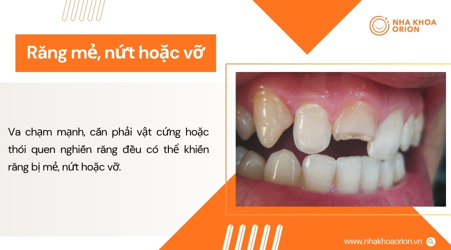 Răng mẻ, nứt hoặc vỡ làm suy yếu cấu trúc răng và ảnh hưởng đến chức năng ăn nhai