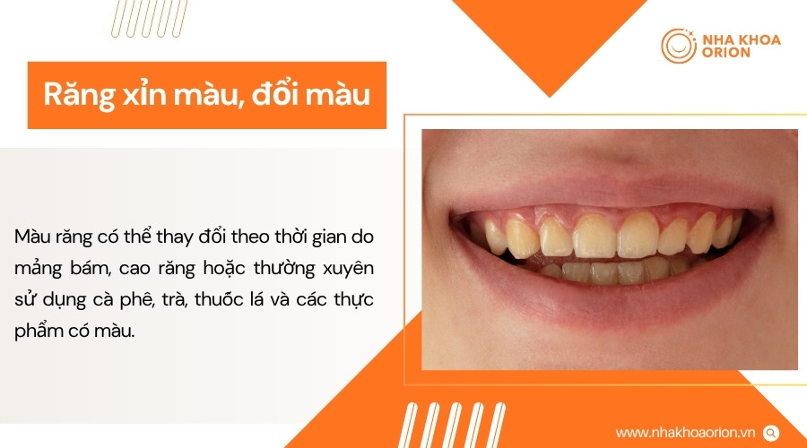 Răng xỉn màu có thể làm giảm thẩm mỹ và xuất phát từ nhiều nguyên nhân khác nhau