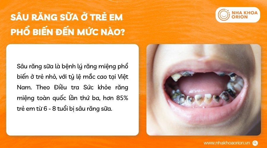 Sâu răng sữa xuất hiện phổ biến ở trẻ nhỏ qua nhiều dấu hiệu khác nhau