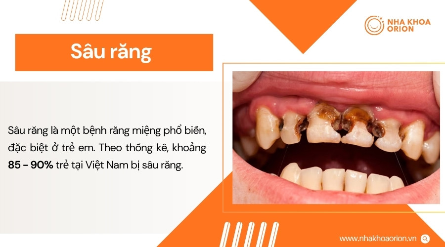 Sâu răng gây tổn thương cấu trúc răng và có thể tiến triển nếu không được điều trị