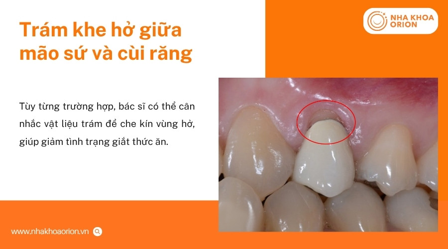 B&aacute;c sĩ c&oacute; thể tr&aacute;m khe hở nhỏ nếu m&atilde;o sứ vẫn đảm bảo khả năng sử dụng