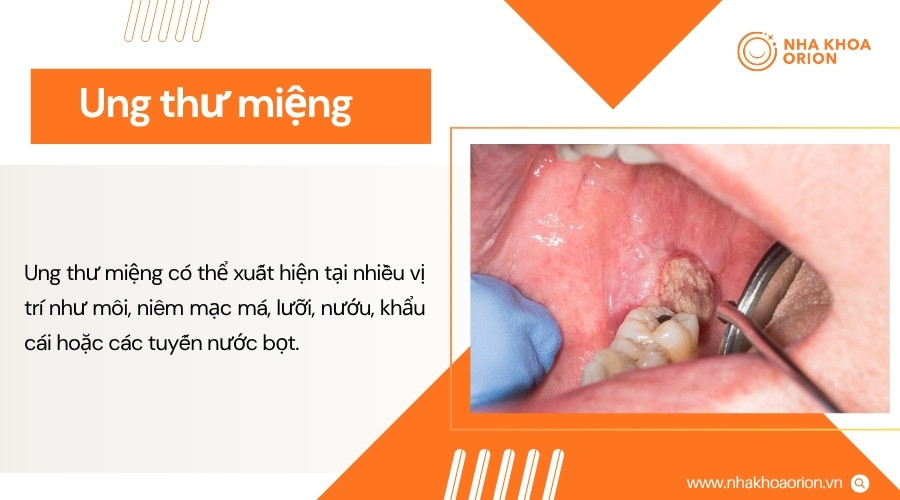 Ung thư miệng có thể gây tổn thương bất thường tại môi, lưỡi, nướu hoặc niêm mạc miệng