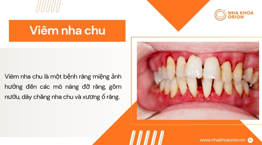 Viêm nha chu làm tổn thương mô nâng đỡ và có thể khiến răng lung lay