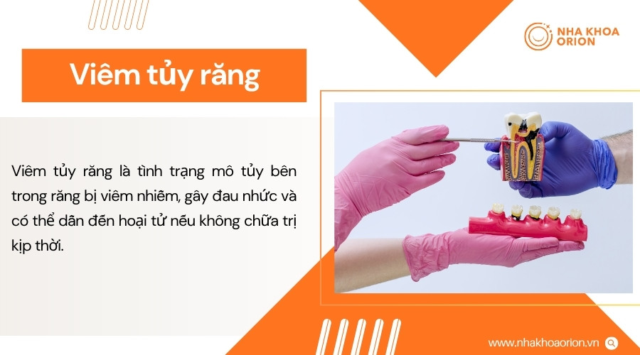 Viêm tủy răng thường gây đau và ê buốt khi mô tủy bên trong bị tổn thương