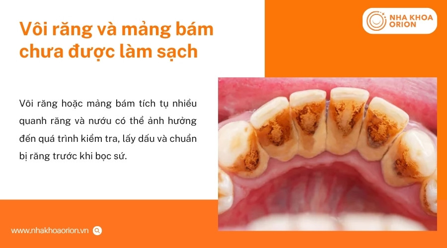 V&ocirc;i răng v&agrave; mảng b&aacute;m c&oacute; thể ảnh hưởng đến qu&aacute; tr&igrave;nh chuẩn bị răng trước phục h&igrave;nh