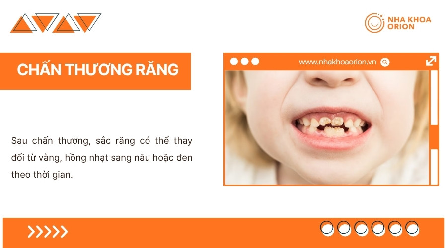 Chấn thương c&oacute; thể khiến m&agrave;u răng thay đổi do tổn thương m&ocirc; b&ecirc;n trong