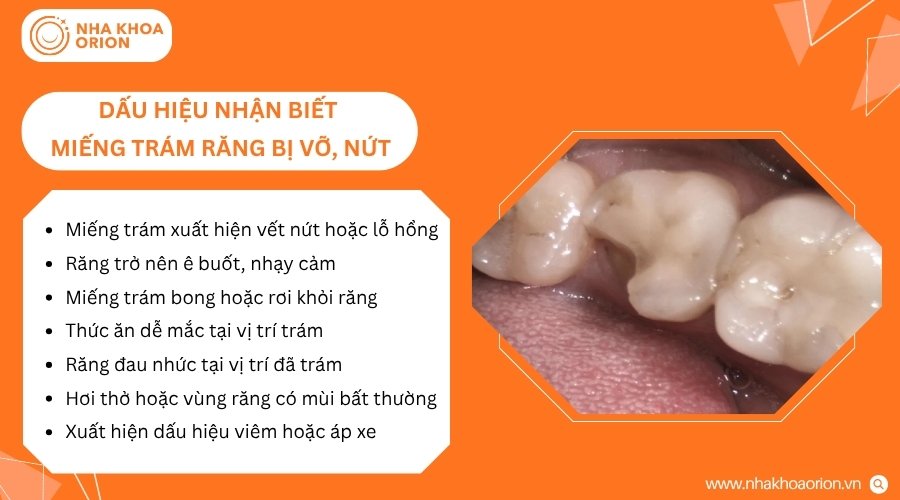 Miếng trám bị hư hỏng thường gây ra những thay đổi rõ rệt tại vị trí răng đã phục hồi