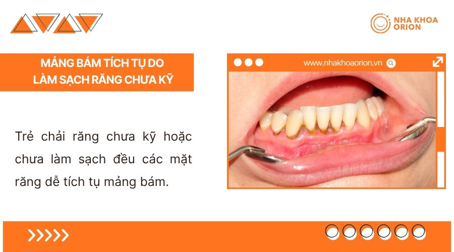 Vệ sinh răng miệng chưa đ&uacute;ng c&aacute;ch khiến mảng b&aacute;m dễ t&iacute;ch tụ tr&ecirc;n răng