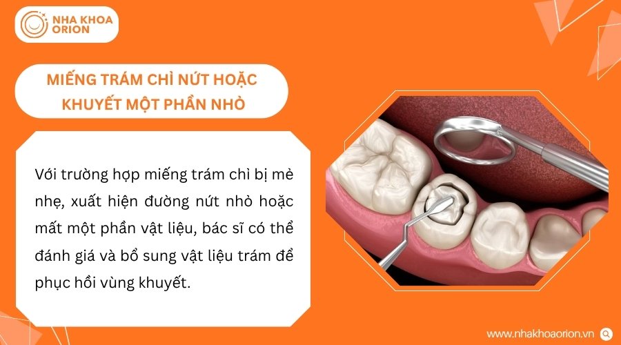 Miếng trám khuyết nhẹ có thể được bác sĩ sửa chữa hoặc bổ sung vật liệu phù hợp
