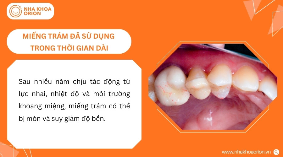 Miếng trám lâu năm có thể bị mòn, nứt hoặc suy giảm khả năng liên kết với răng