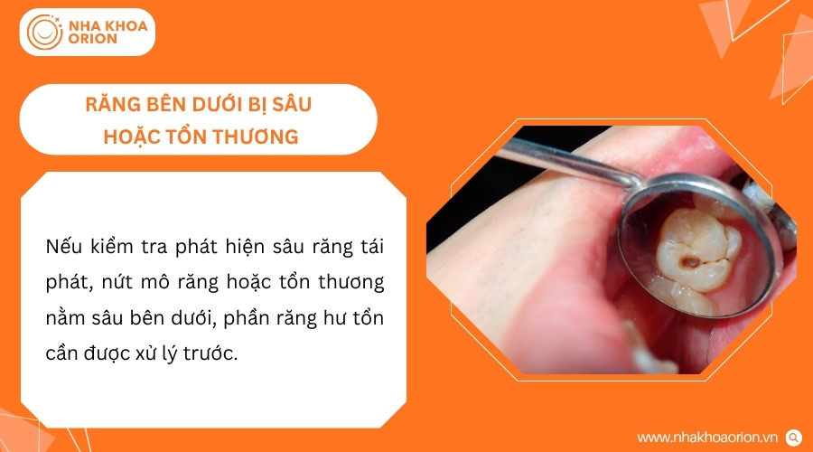 Răng bị sâu hoặc tổn thương cần được xử lý trước khi bác sĩ phục hồi lại miếng trám