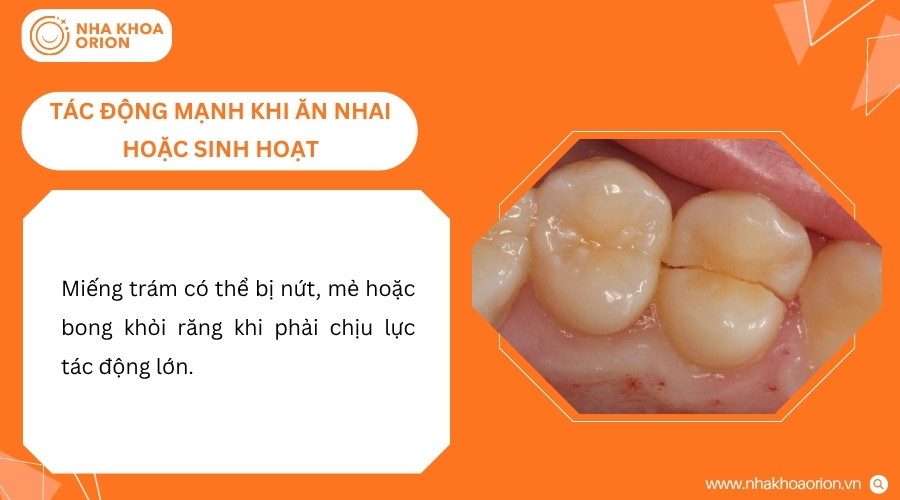 Lực tác động lớn có thể khiến miếng trám bị nứt, mẻ hoặc bong khỏi bề mặt răng