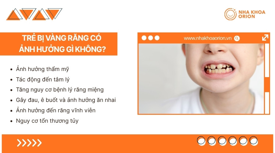 Răng v&agrave;ng c&oacute; thể ảnh hưởng đến thẩm mỹ v&agrave; sức khỏe răng miệng của trẻ