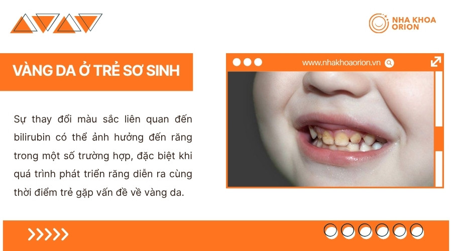 V&agrave;ng da sơ sinh c&oacute; thể li&ecirc;n quan đến thay đổi m&agrave;u sắc răng trong một số trường hợp