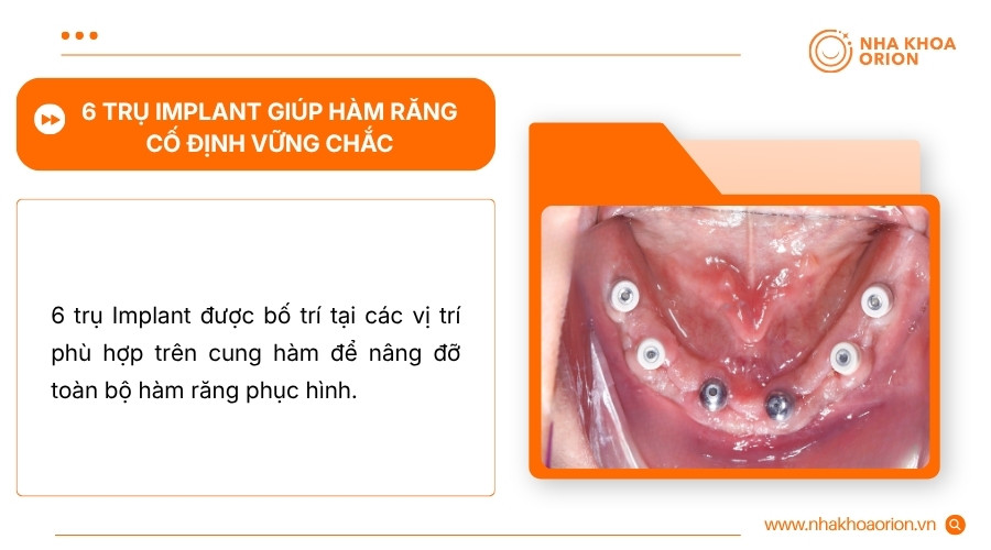 6 trụ Implant tạo nhiều điểm n&acirc;ng đỡ, gi&uacute;p h&agrave;m răng phục h&igrave;nh ổn định hơn khi ăn nhai
