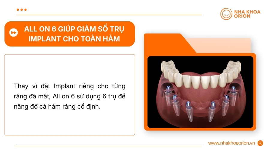 All on 6 sử dụng 6 trụ để n&acirc;ng đỡ cả h&agrave;m răng thay v&igrave; cấy Implant ri&ecirc;ng cho từng răng