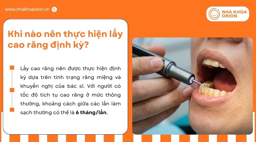 Tần suất lấy cao răng cần được điều chỉnh dựa tr&ecirc;n t&igrave;nh trạng răng miệng của từng người