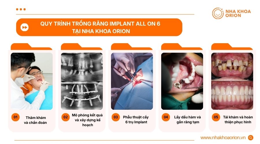 Quy tr&igrave;nh c&aacute;c bước trồng Implant All on 6 tại Nha khoa Orion&nbsp;