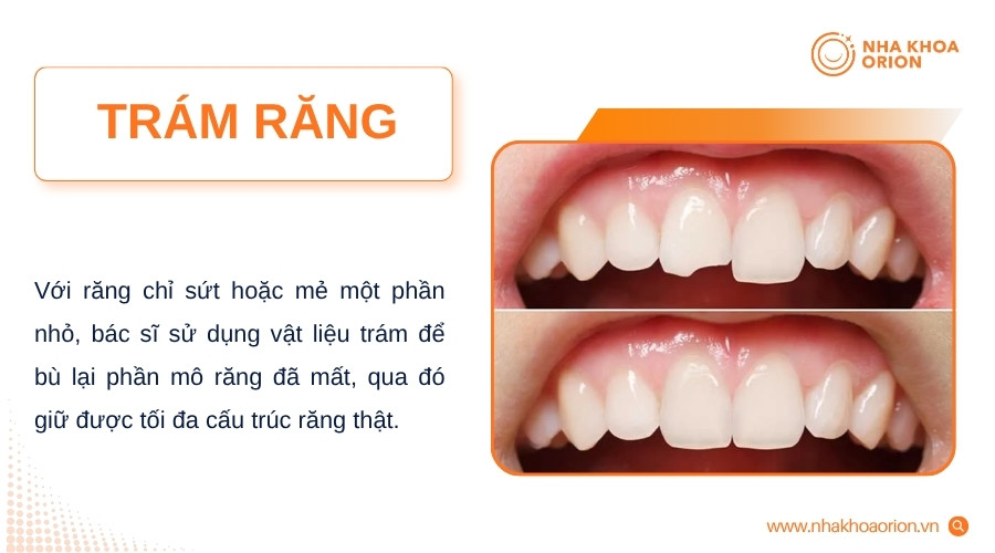 Răng mẻ nhẹ có thể được phục hồi bằng vật liệu trám