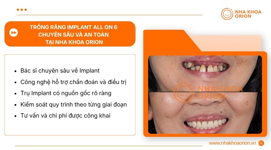 Nha khoa Orion kết hợp b&aacute;c sĩ chuy&ecirc;n m&ocirc;n với c&ocirc;ng nghệ Implant hiện đại